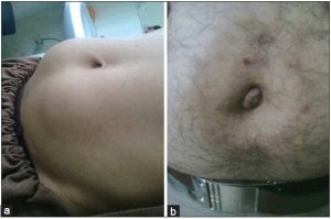 Lipo-hipertrofia (a) e lipoatrofia (b). Fonte: Mokta, J. K., Mokta, K. K., Panda P. Insulin lipodystrophy and lipohypertrophy. Indian J Endocrinol Metab. 2013. 17 (4).